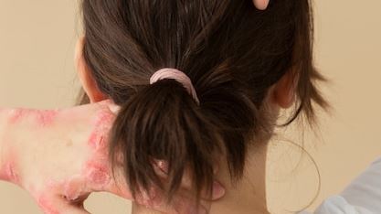 Recognizing Different Types of Skin Rashes: A Guide to Effective Diagnosis and Care