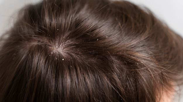 Does Dermatitis Scalp Look Like Other Common Scalp Conditions? An In-Depth Comparison