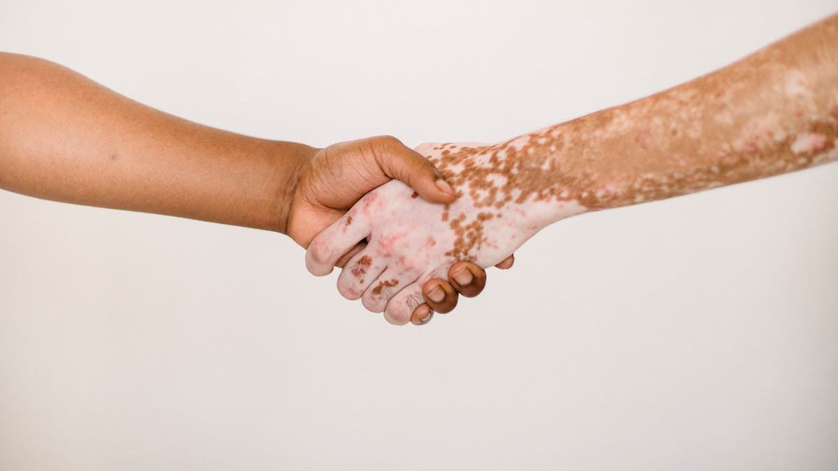 Recognizing the Signs: What Does Severe Psoriasis Rash Look Like in Different Patients?