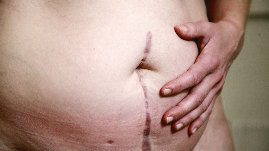 Recognizing and Addressing Crohn Symptoms in Women: A Deep Dive into Symptoms, Diagnosis, and Treatments
