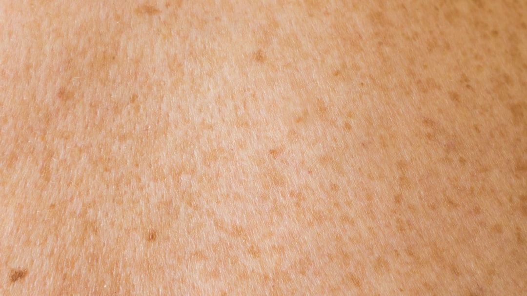 What Does Vitiligo Skin Look Like? A Comprehensive Examination