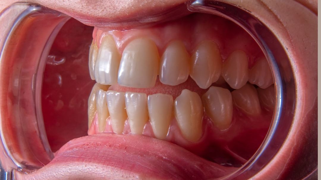 Full Mouth Dental Implants: The Modern Solution for Complete Smile Restoration