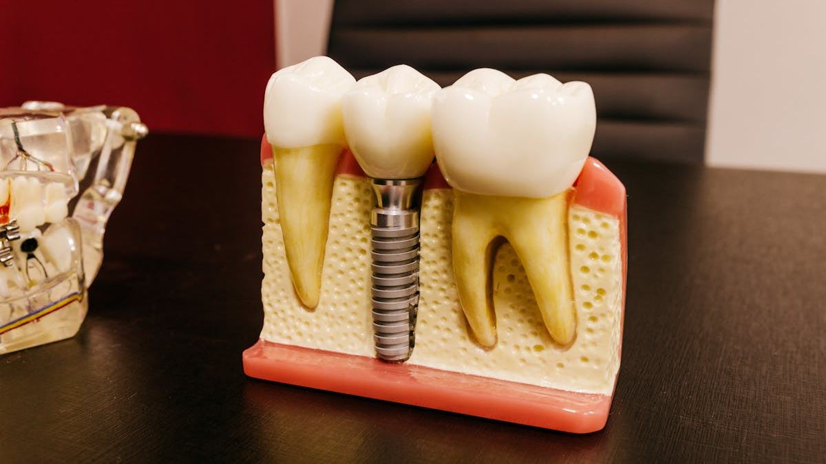 How to Budget for Dental Implants: A Patient’s Guide to Managing Costs in the U.S.
