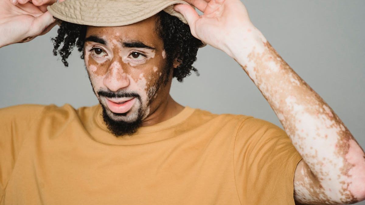 Does Vitiligo Look Like, and What Should You Expect? A Detailed Overview