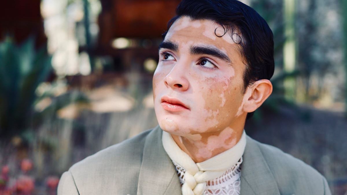 What Does Vitiligo Looks Like? A Visual and Emotional Overview