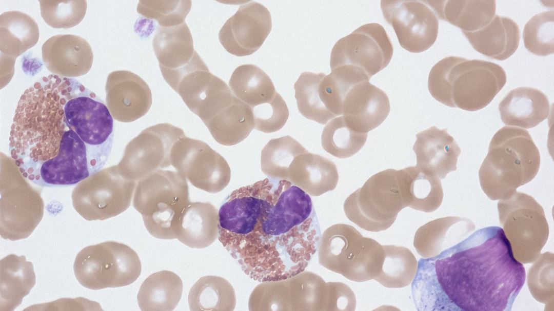 Innovative Hemophilia Treatment Options Shaping the Future of Care in the US